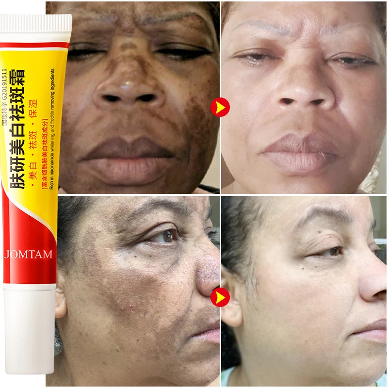 Whitening Freckle Cream Face B - Skincare Glad2Glow reseña y precio
